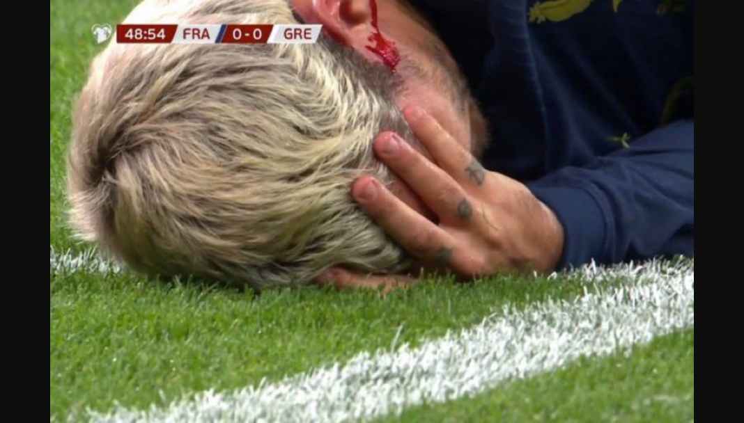 Cedera kepala Antoine Griezmann Kartu Merah, Cedera Kepala Griezmann, Penalti Gagal Mbappe Warnai Laga Timnas Perancis