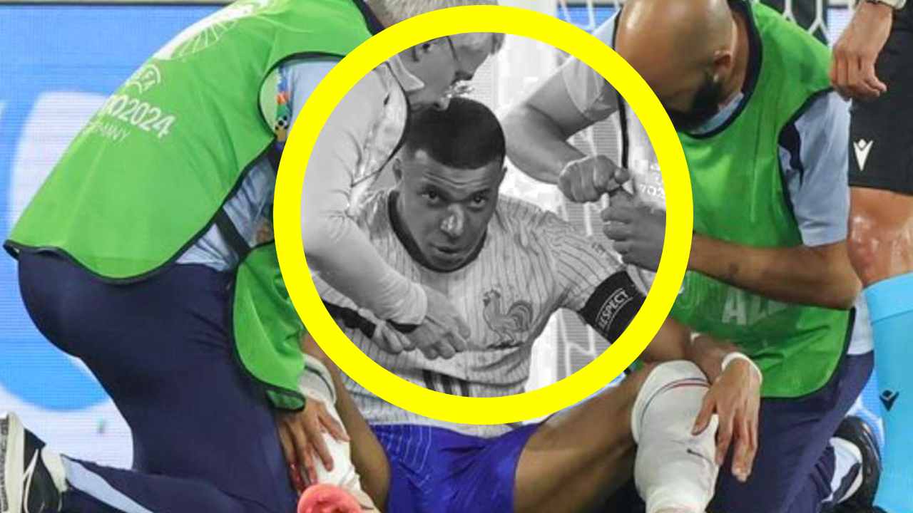 Hidung Kylian Mbappe patah dan tampak bengkok