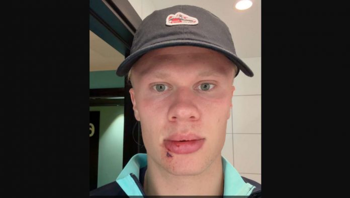 Erling Haaland pemain Manchester City luka kena pintu bus Erling Haaland pemain Manchester City luka kena pintu bus